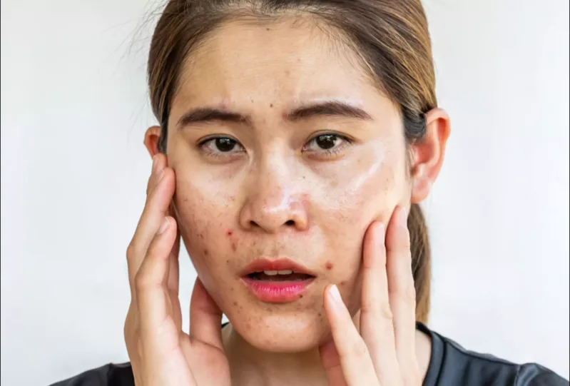 Sử dụng quá nhiều serum hoặc kem dưỡng có thể khiến da bết dính và khó hấp thụ